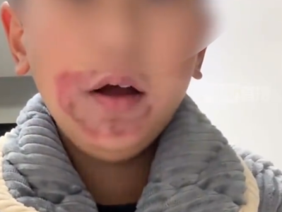 10岁男孩经常舔嘴唇舔出“羊胡子疮” 不是大病却非常折磨人 ！